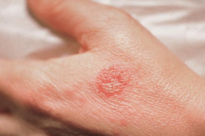 화폐상 습진(nummular eczema)