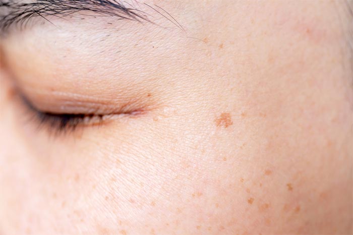 검버섯 (Age spot)