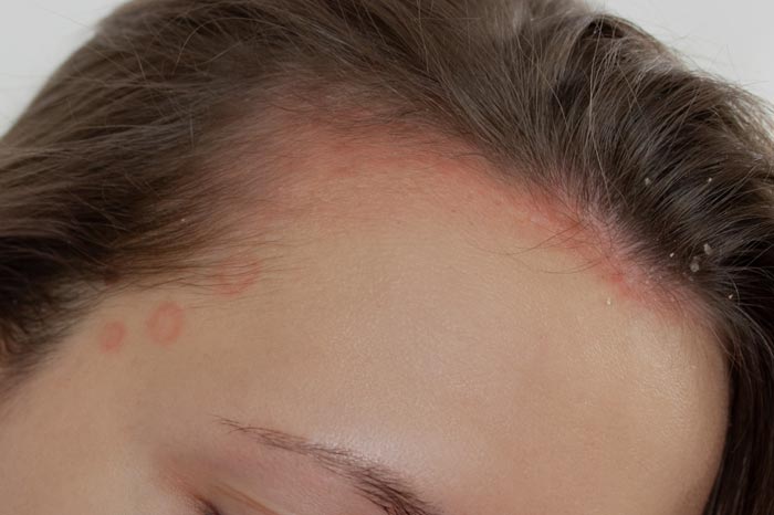 지루성 피부염, 제대로 알고 안전하게 치료하기